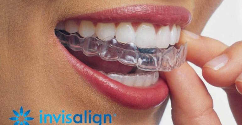 Invisalign at Merrylee Dental Practice