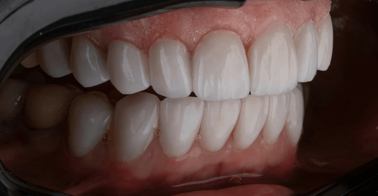 Merrylee Dental Practice Clip Veneers